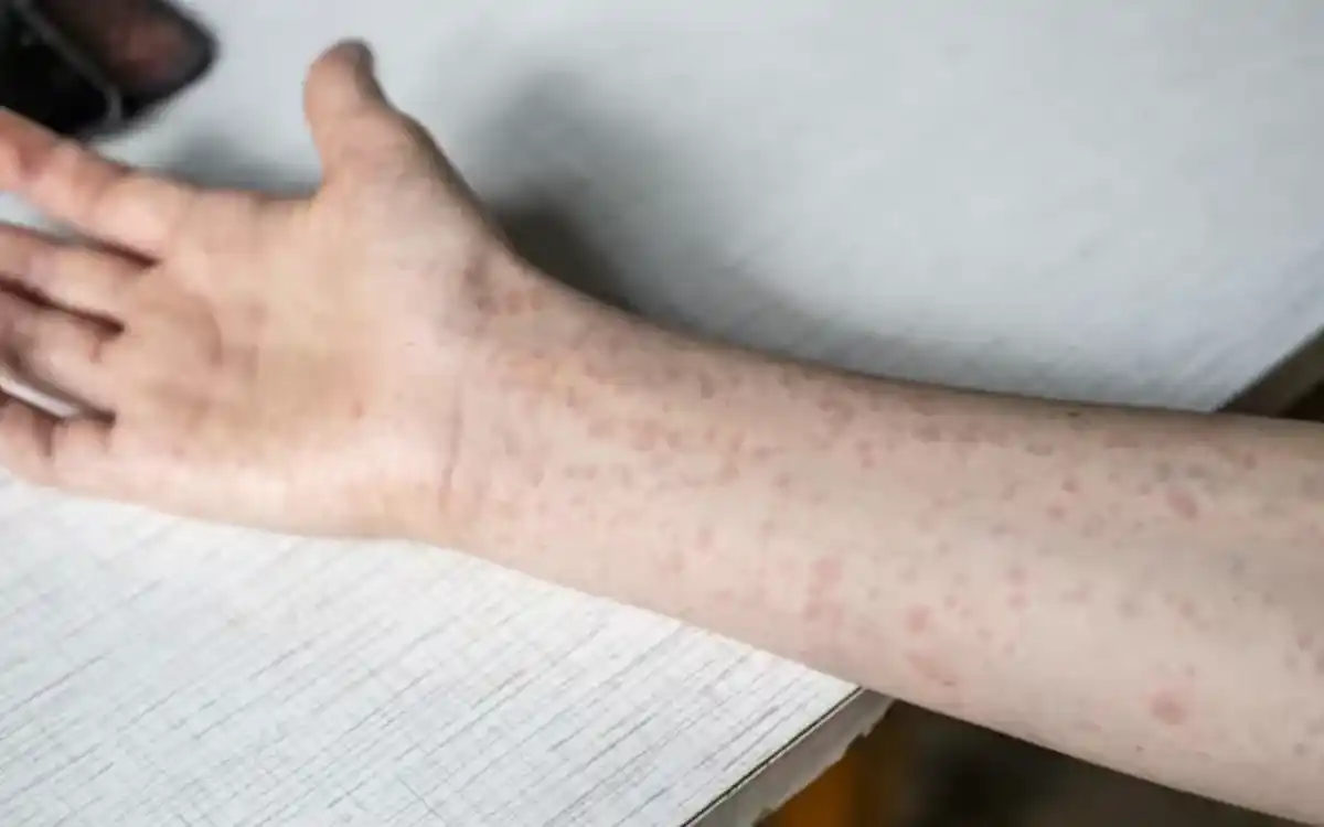 シンガポールで麻疹の発生が報告された。